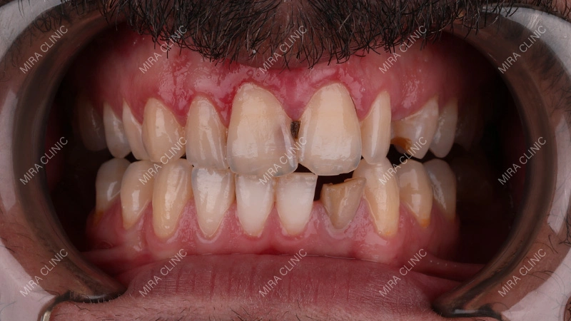 Dental Problems